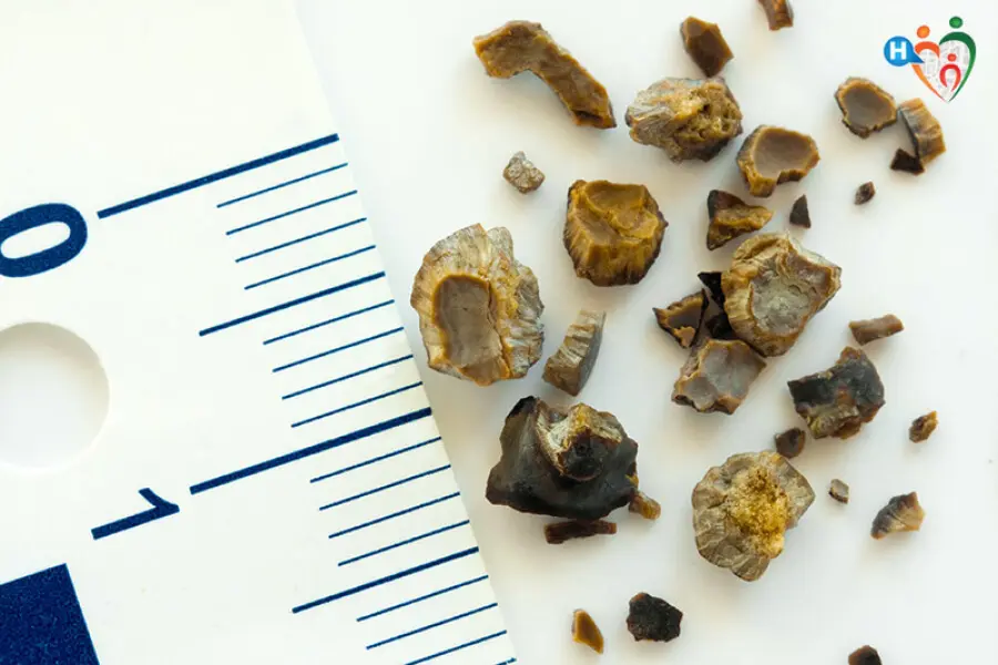 Come rimuovere i calcoli renali?