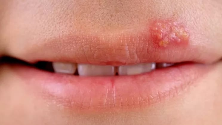 Rimedi naturali per combattere l'herpes